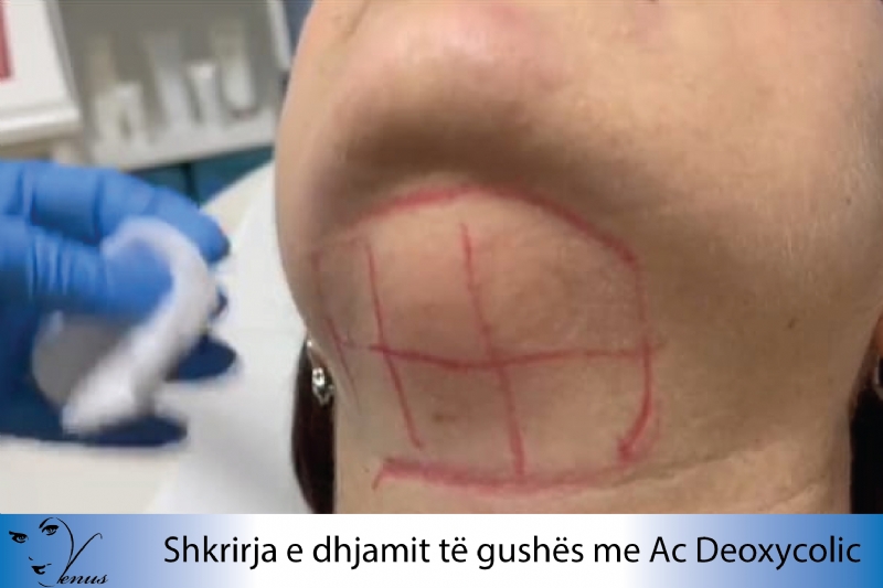 Shkrirja e dhjamit te gushes me Acid Deoxycolic, Trajtim estetik per gushen me procedurë jo kirurgjikale, Klinika per trajtimin e gushes, Klinika ne tirane per lekuren e gushes, Klinika Dermatologjise Kozmetike Venus